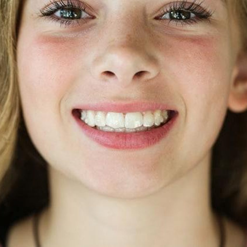 Invisalign's biggest strength is that it's nearly invisible | OoLi ...