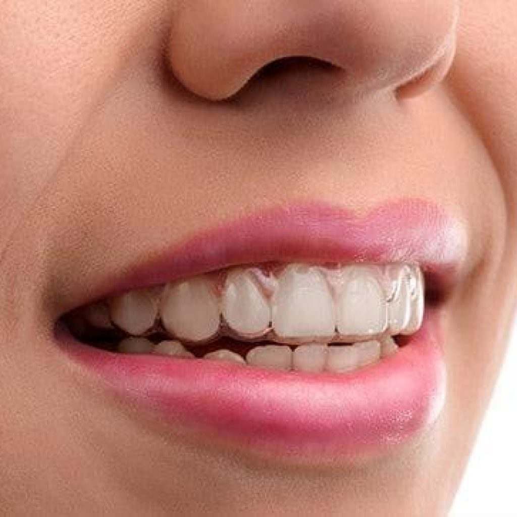 nighttime-clear-aligners-only-from-smile-direct-club