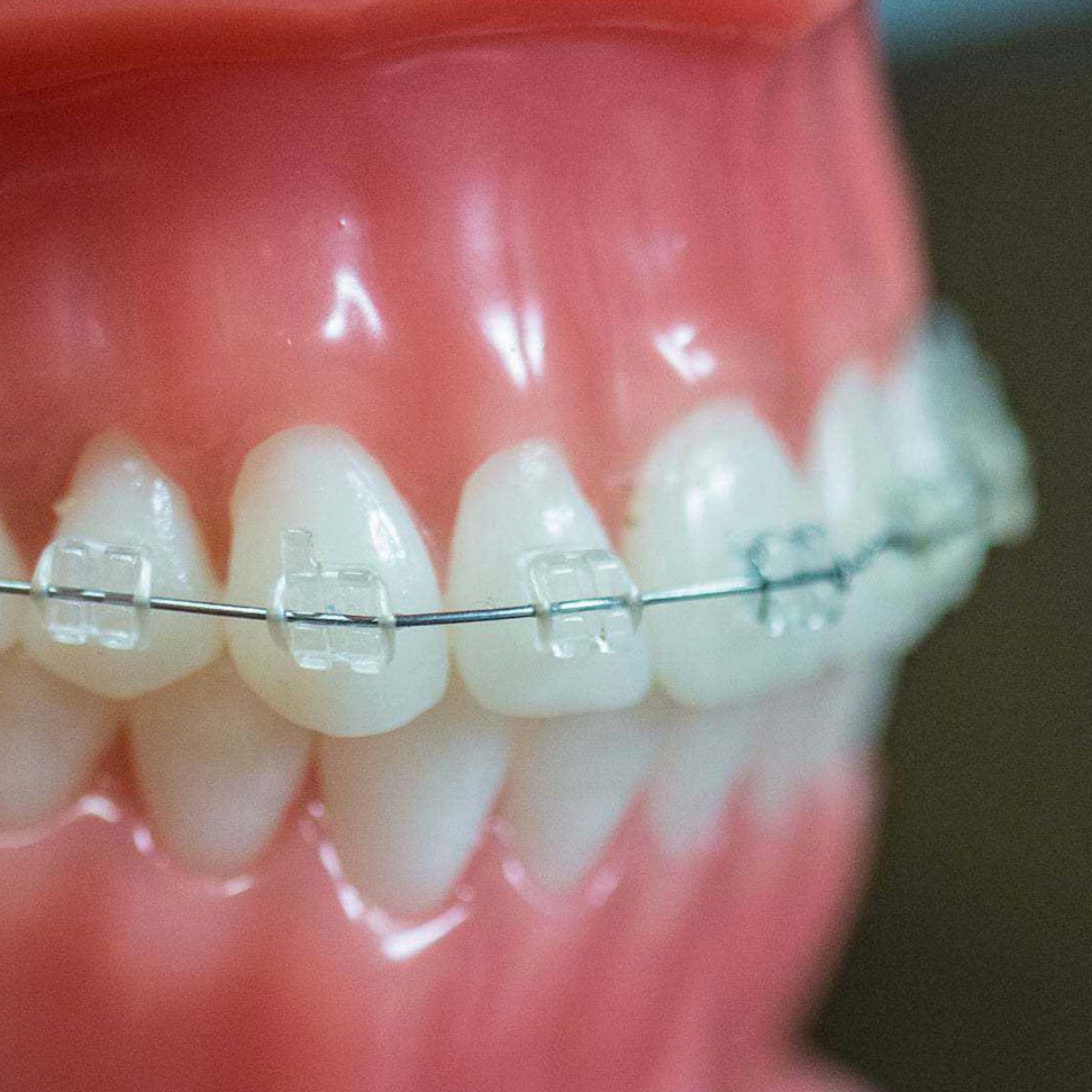 Clear ceramic braces in Phoenix OoLi Orthodontics