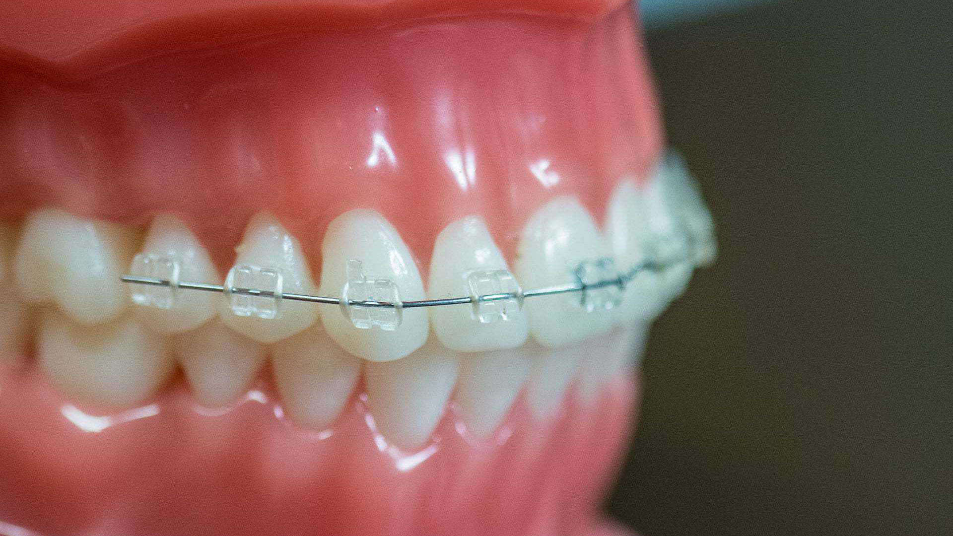 Clear Ceramic Braces With Colored Bands Clear Ceramic Braces With Colored Bands