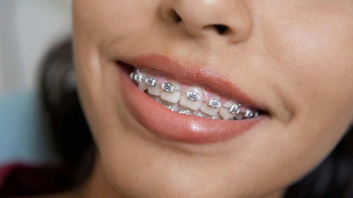 Traditional metal braces in Phoenix OoLi Orthodontics