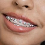 Braces Treatment Phoenix Orthodontist