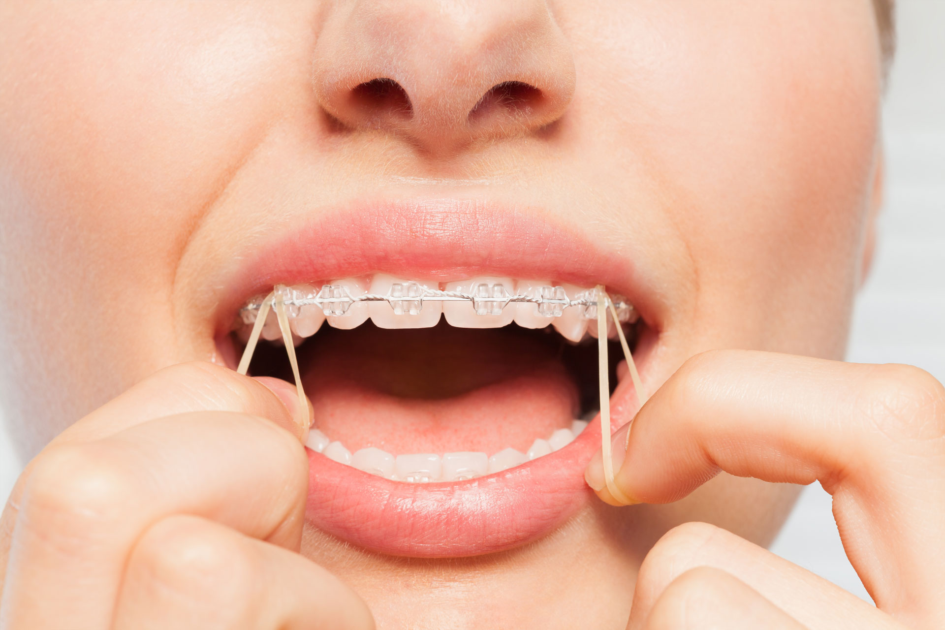  what does the elastics do for braces