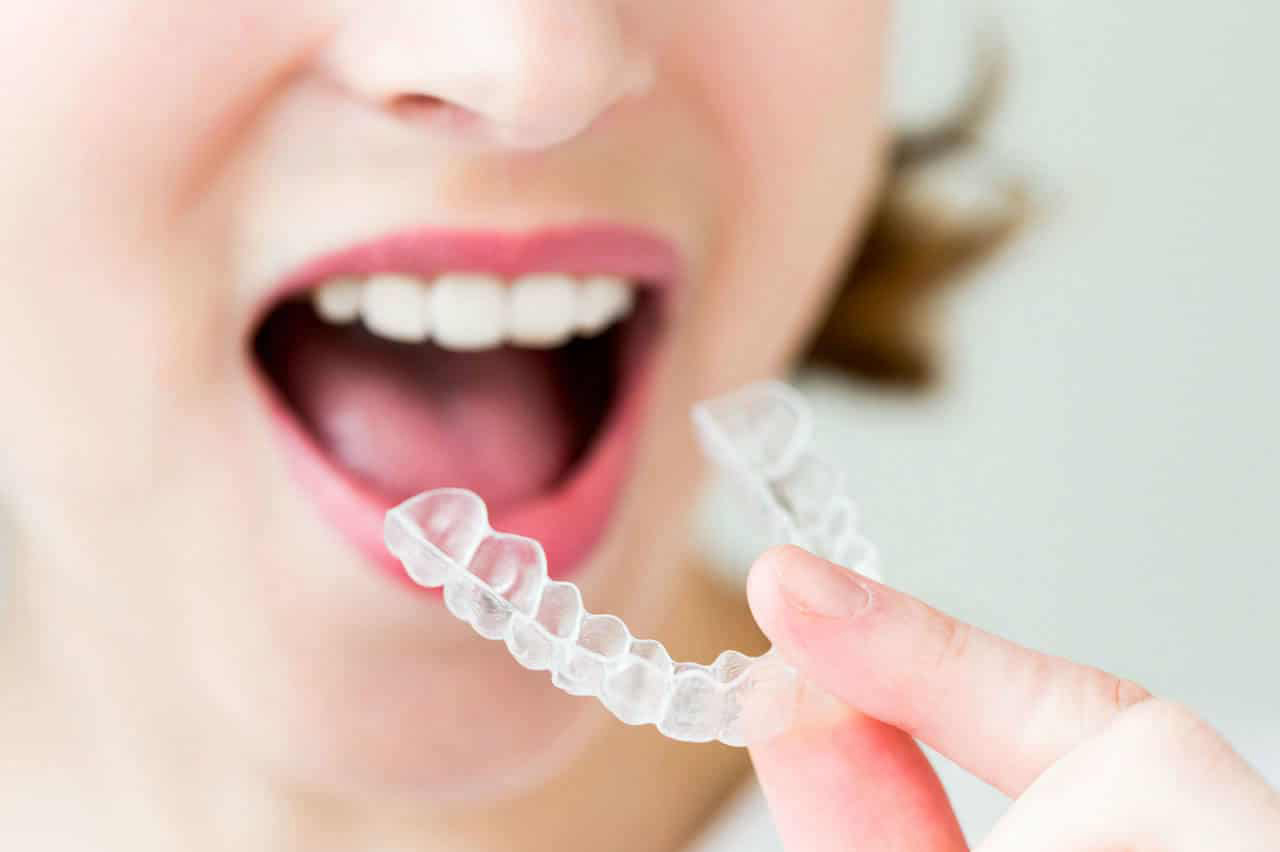 Life With Invisalign: What to Expect With Invisible Braces