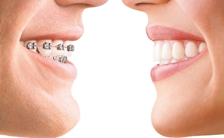 invisalign-vs-braces-pros-cons-comparison-phoenix-orthodontist-cropped