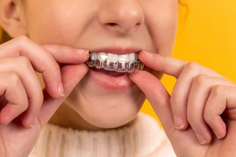How Long Do Braces Take? What to Expect When Getting Them