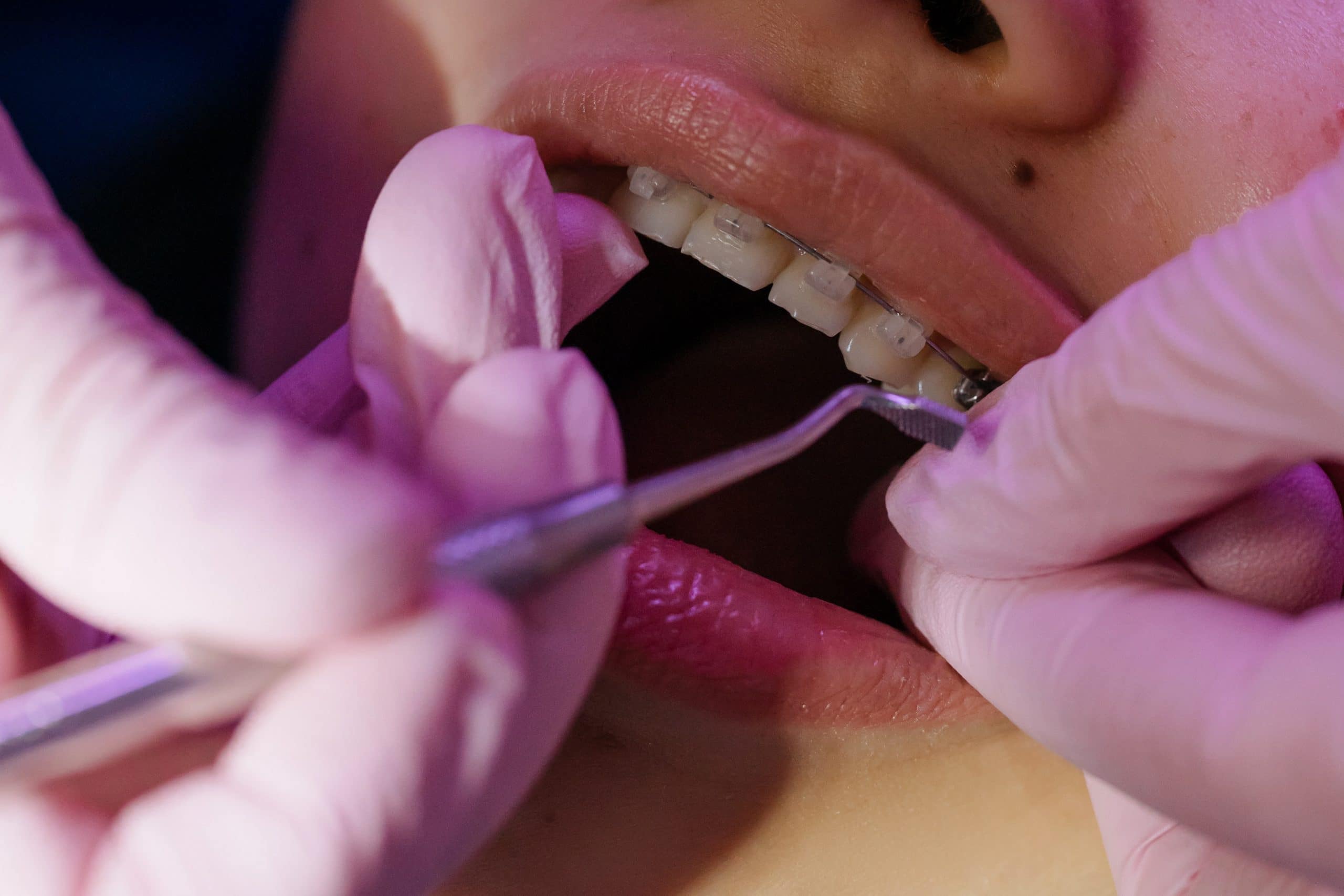 braces procedure scaled