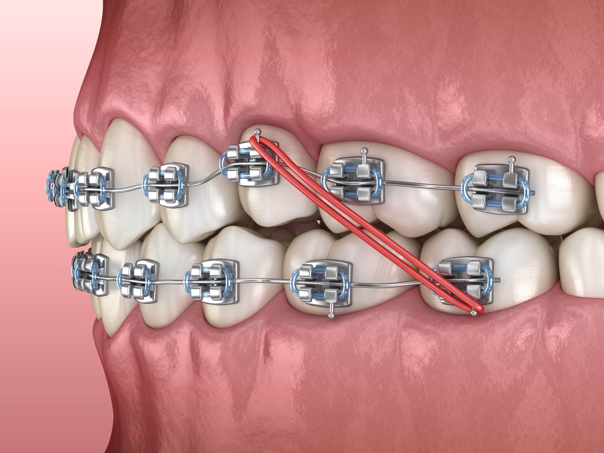 Rubber Bands in Your Mouth Why You Need to Wear Elastics for Braces