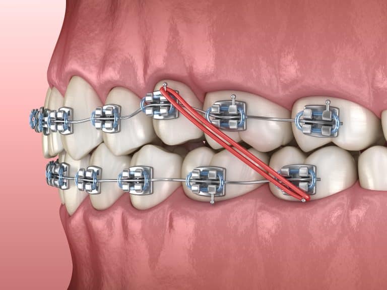 Rubber Bands in Your Mouth Why You Need to Wear Elastics for Braces
