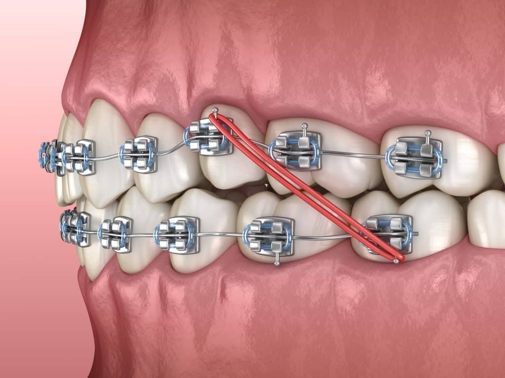 How Long to Wear Rubber Bands for Braces