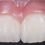 Missing lateral incisors
